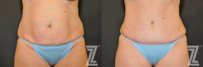 Austin Tummy Tuck Before & After Gallery - Patient 132886883 - Image 1 - The Piazza Center