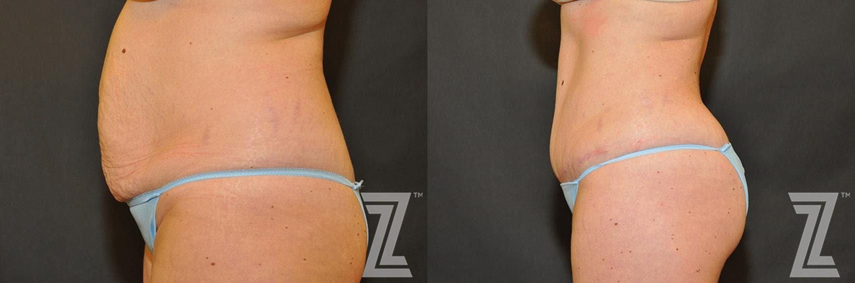 Tummy Tuck Before & After Gallery - Patient 132886883 - Image 2