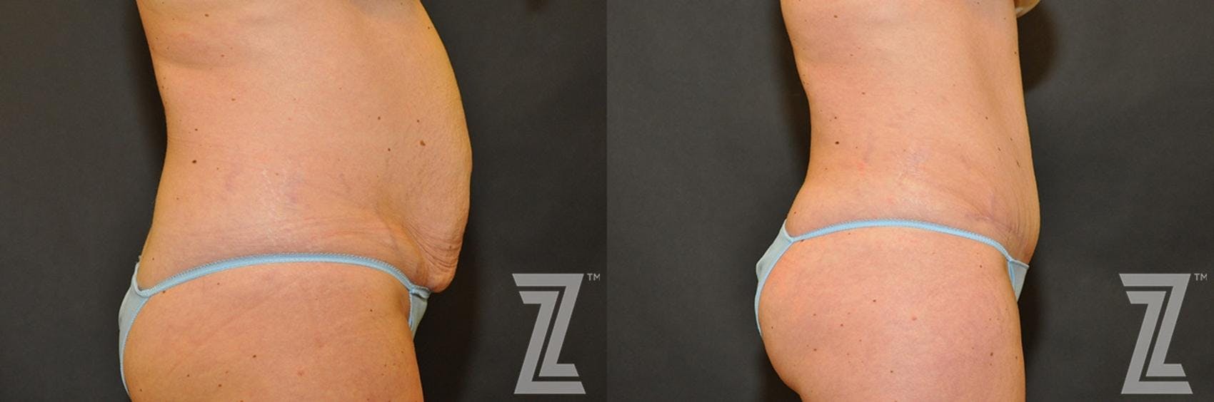 Tummy Tuck Before & After Gallery - Patient 132886883 - Image 4