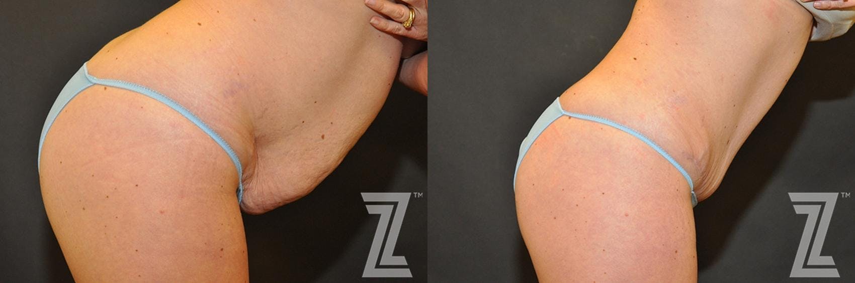 Tummy Tuck Before & After Gallery - Patient 132886883 - Image 5