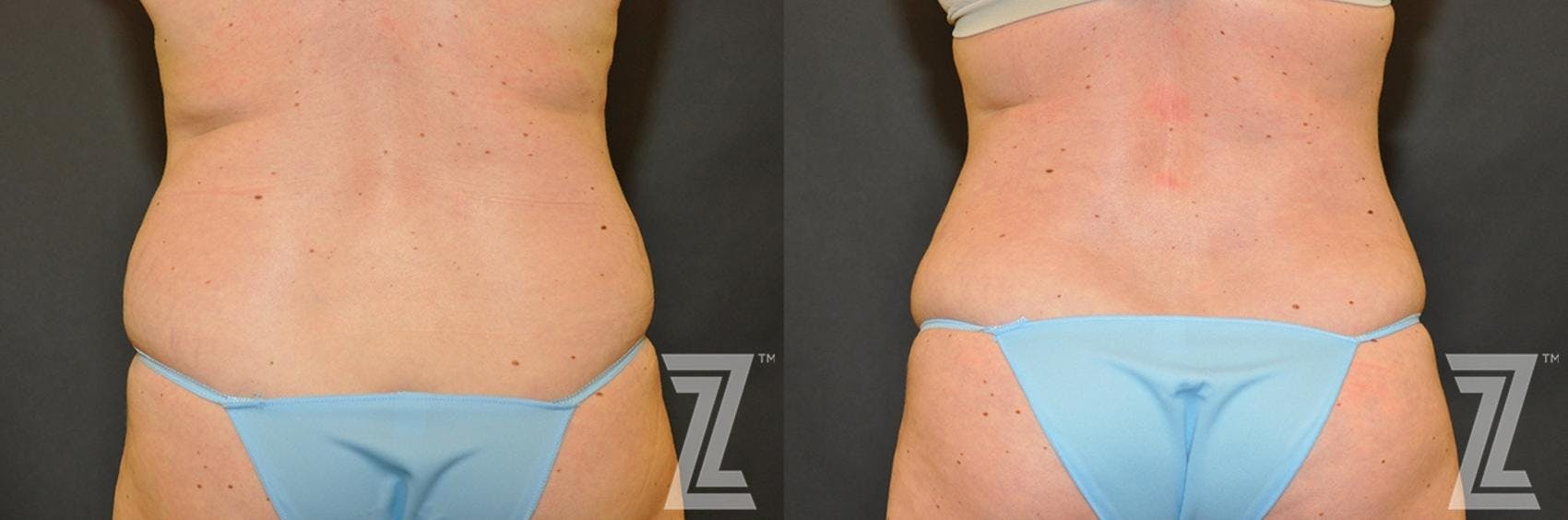 Tummy Tuck Before & After Gallery - Patient 132886883 - Image 6