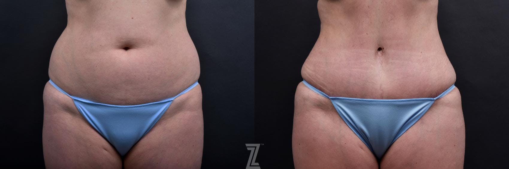 Tummy Tuck Before & After Gallery - Patient 132886885 - Image 1