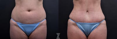 Austin Tummy Tuck Before & After Gallery - Patient 132886885 - Image 1 - The Piazza Center