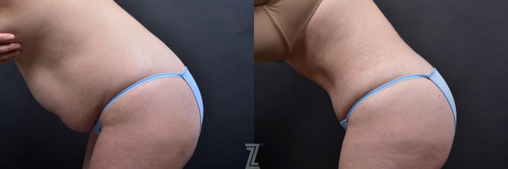Tummy Tuck Before & After Gallery - Patient 132886885 - Image 3