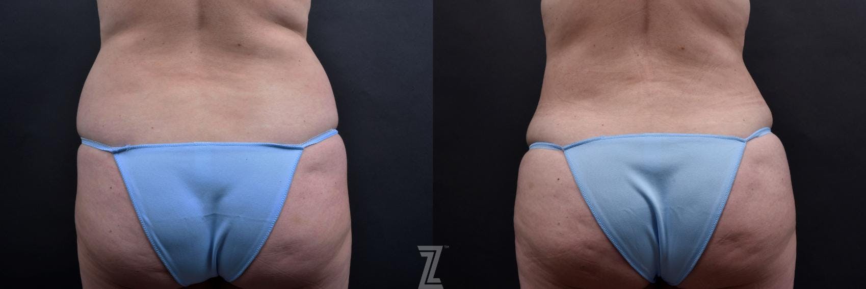 Tummy Tuck Before & After Gallery - Patient 132886885 - Image 4