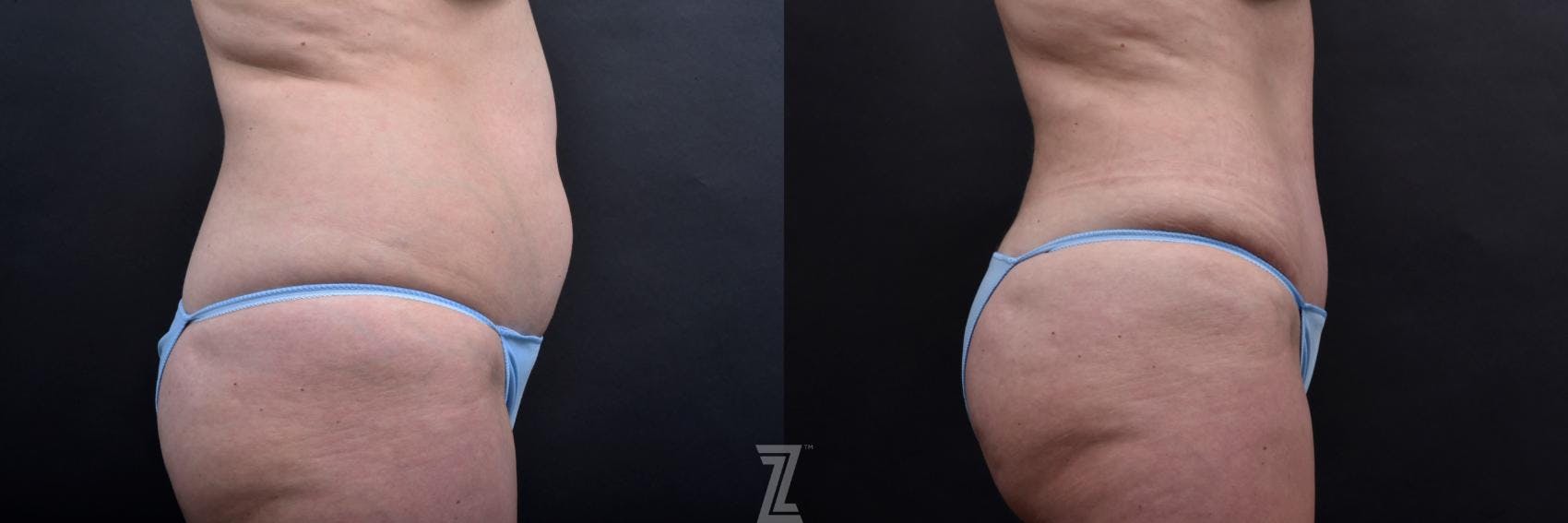 Tummy Tuck Before & After Gallery - Patient 132886885 - Image 5