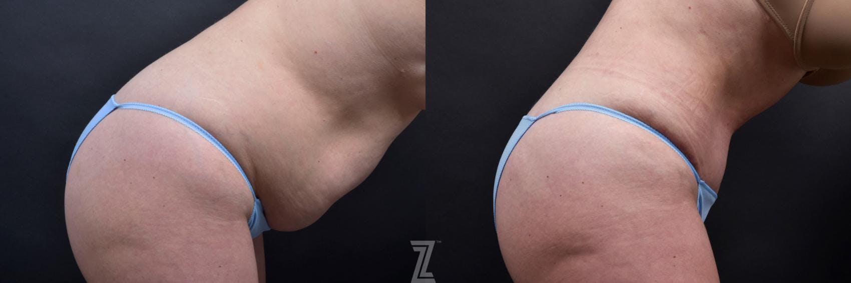 Tummy Tuck Before & After Gallery - Patient 132886885 - Image 6
