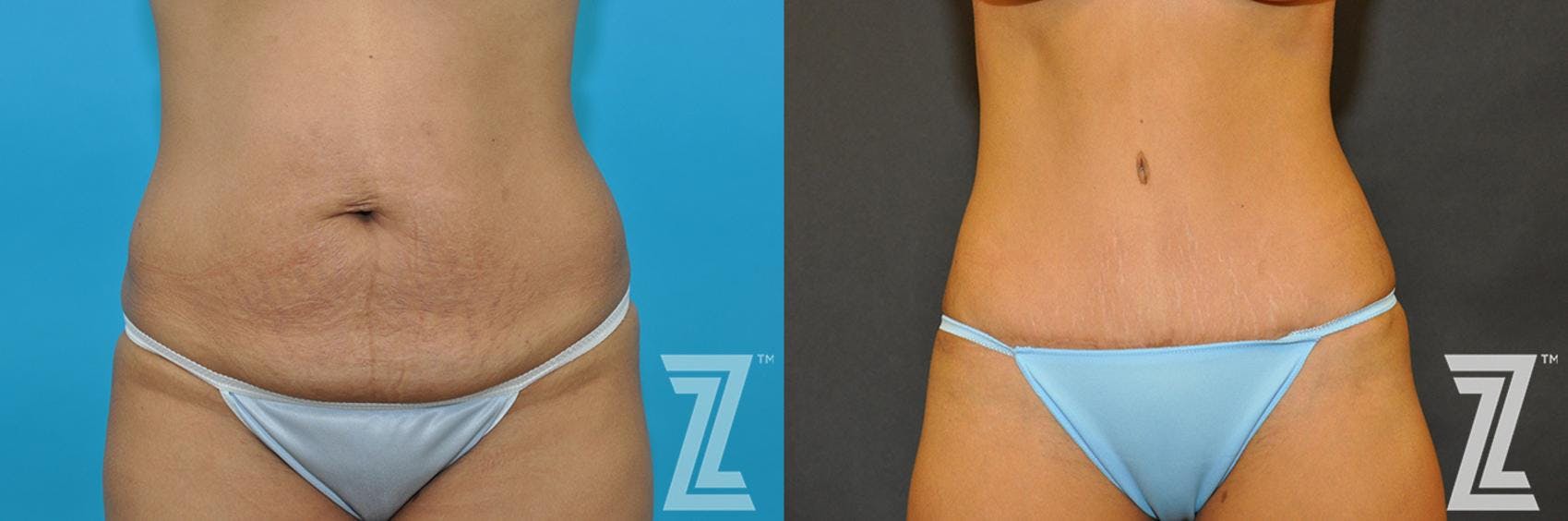 Tummy Tuck Before & After Gallery - Patient 132886888 - Image 1