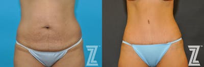 Austin Tummy Tuck Before & After Gallery - Patient 132886888 - Image 1 - The Piazza Center