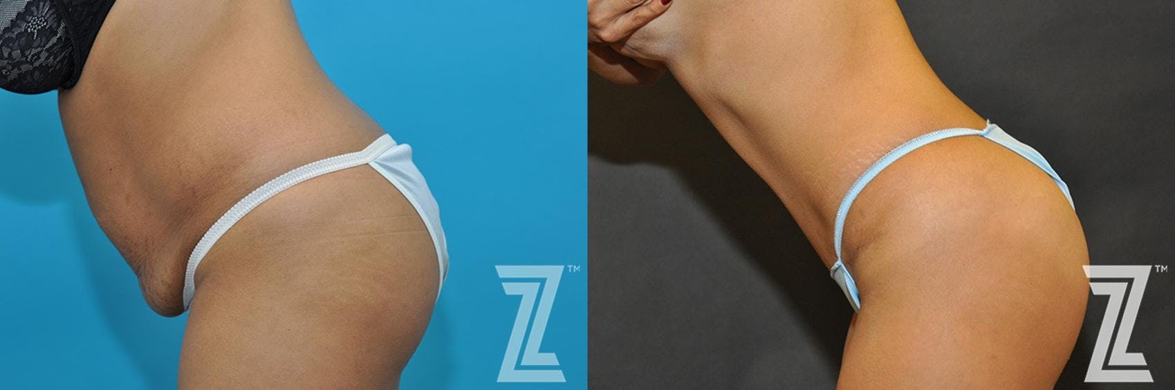 Tummy Tuck Before & After Gallery - Patient 132886888 - Image 3