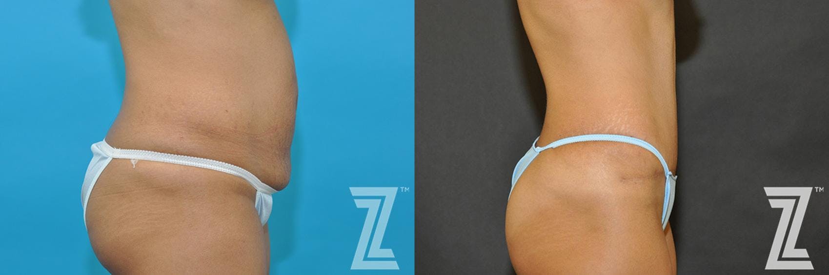 Tummy Tuck Before & After Gallery - Patient 132886888 - Image 4