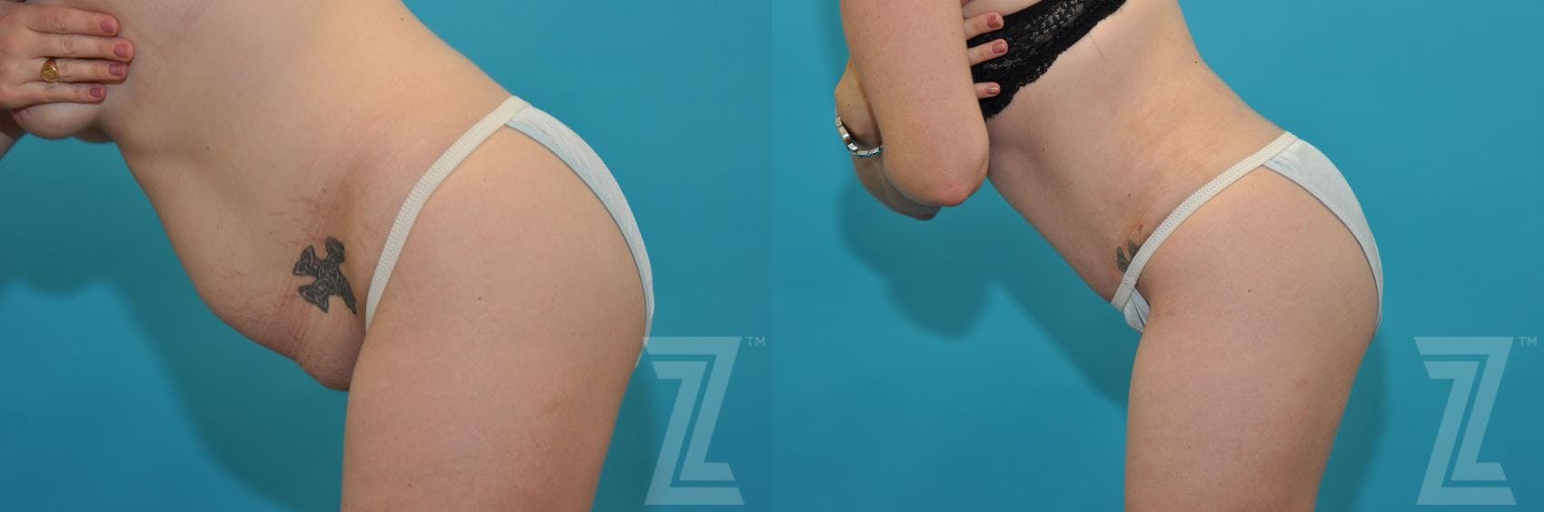 Tummy Tuck Before & After Gallery - Patient 132886890 - Image 3