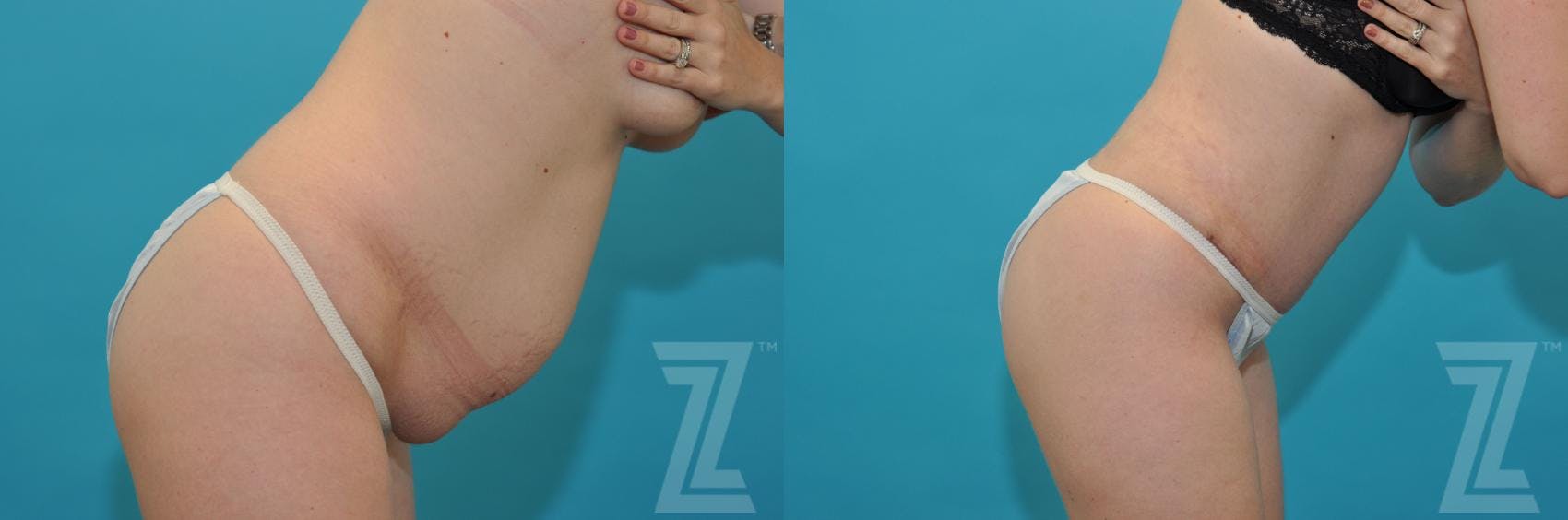 Tummy Tuck Before & After Gallery - Patient 132886890 - Image 5
