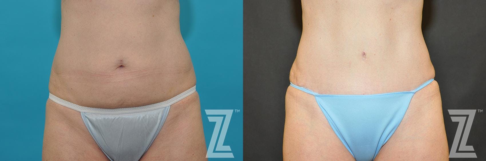 Tummy Tuck Before & After Gallery - Patient 132886891 - Image 1