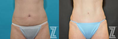 Austin Tummy Tuck Before & After Gallery - Patient 132886891 - Image 1 - The Piazza Center