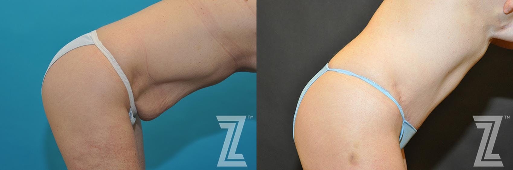 Tummy Tuck Before & After Gallery - Patient 132886891 - Image 5