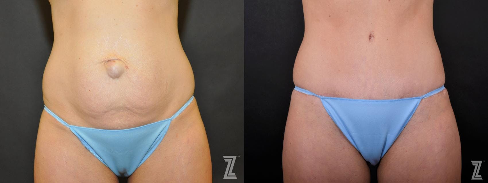 Tummy Tuck Before & After Gallery - Patient 132886895 - Image 1