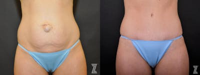 Austin Tummy Tuck Before & After Gallery - Patient 132886895 - Image 1 - The Piazza Center