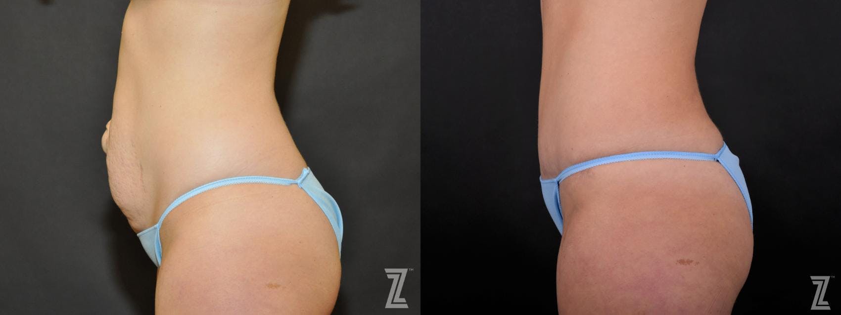 Tummy Tuck Before & After Gallery - Patient 132886895 - Image 2