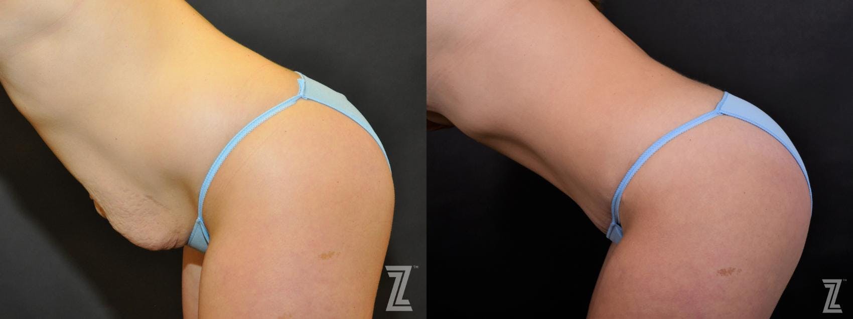 Tummy Tuck Before & After Gallery - Patient 132886895 - Image 3