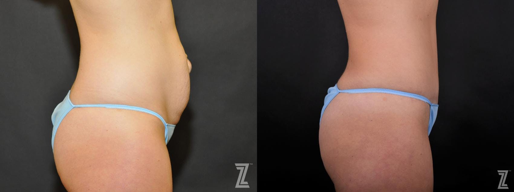 Tummy Tuck Before & After Gallery - Patient 132886895 - Image 4