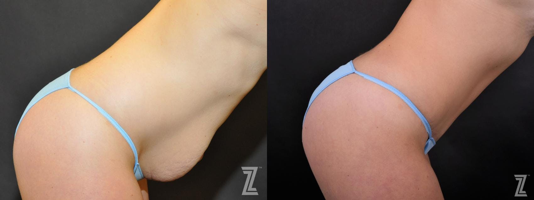 Tummy Tuck Before & After Gallery - Patient 132886895 - Image 5