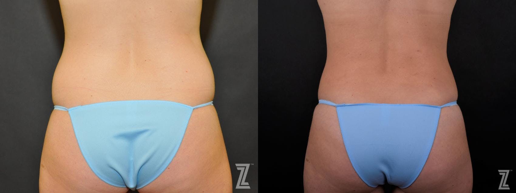 Tummy Tuck Before & After Gallery - Patient 132886895 - Image 6