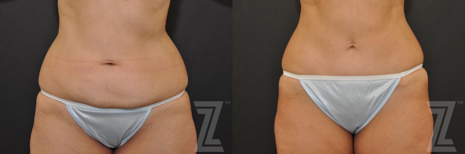 Austin Tummy Tuck Before & After Gallery - Patient 132886896 - Image 1 - The Piazza Center