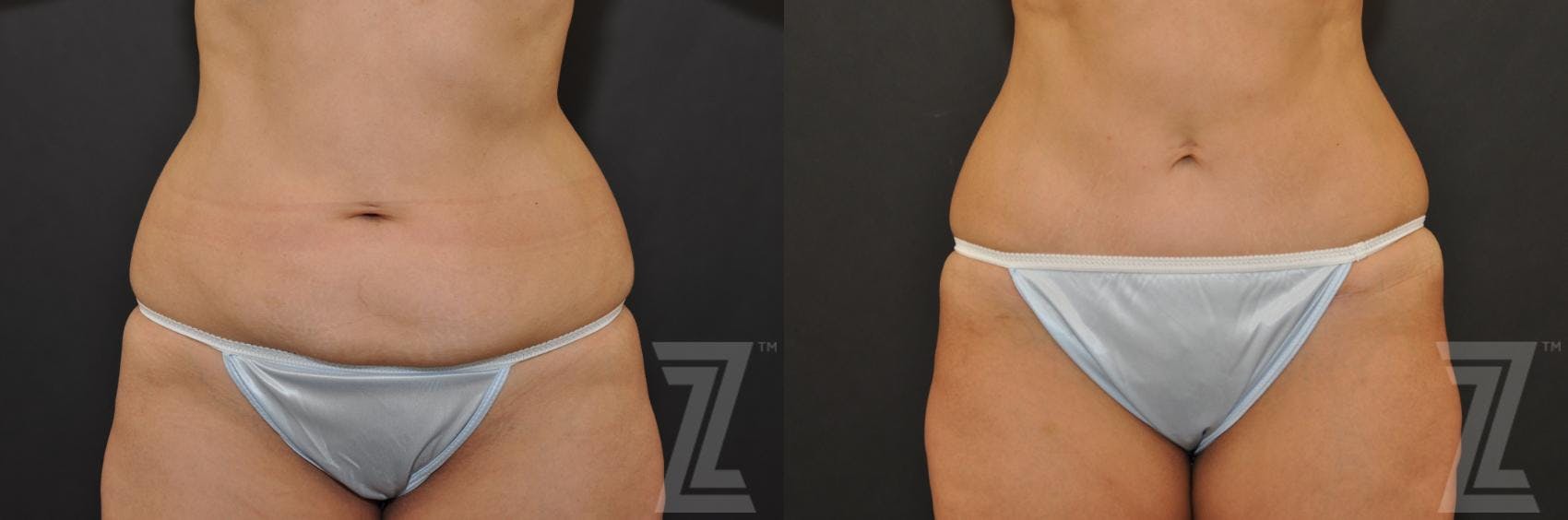 Tummy Tuck Before & After Gallery - Patient 132886896 - Image 1