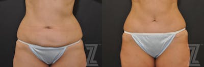 Austin Tummy Tuck Before & After Gallery - Patient 132886896 - Image 1 - The Piazza Center