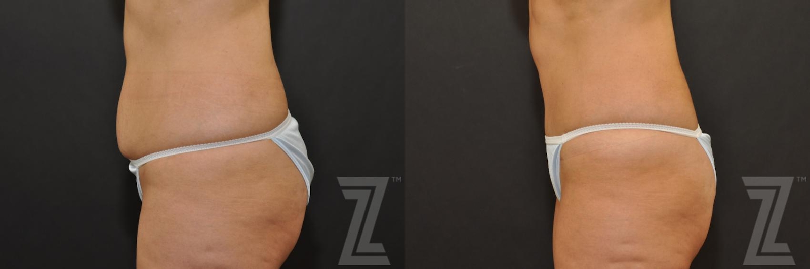 Austin Tummy Tuck Before & After Gallery - Patient 132886896 - Image 2 - The Piazza Center