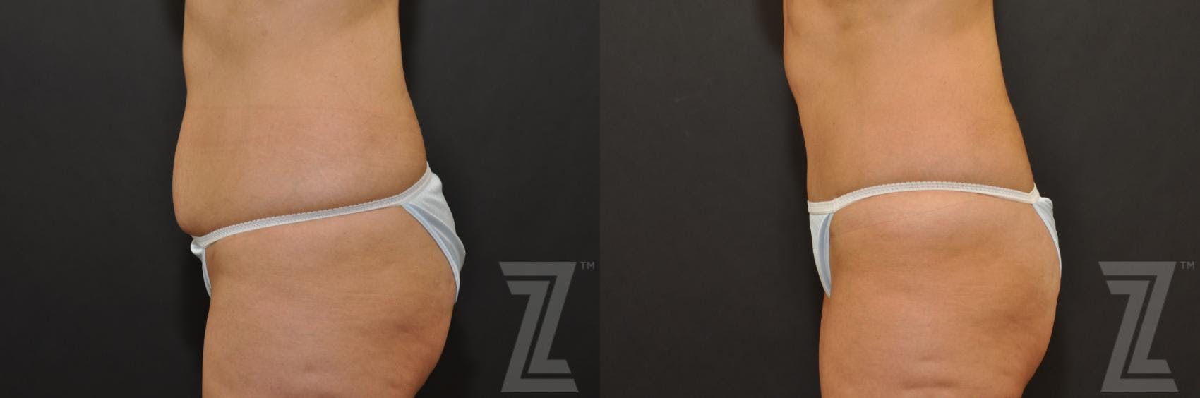 Tummy Tuck Before & After Gallery - Patient 132886896 - Image 2