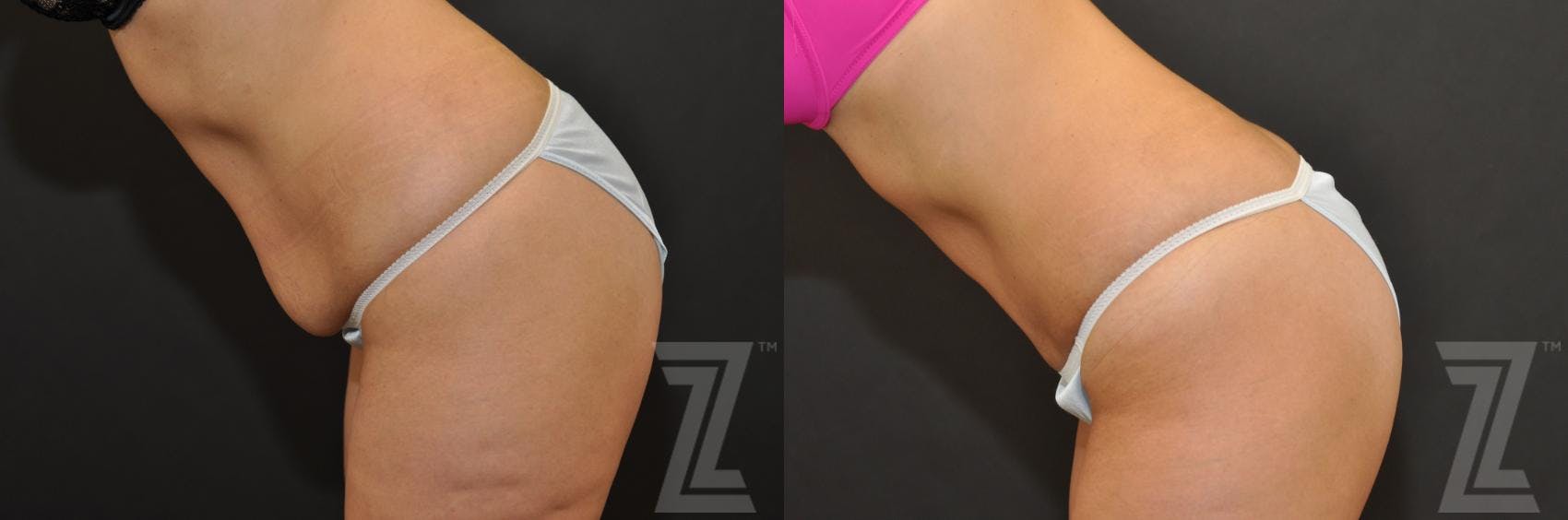 Tummy Tuck Before & After Gallery - Patient 132886896 - Image 3