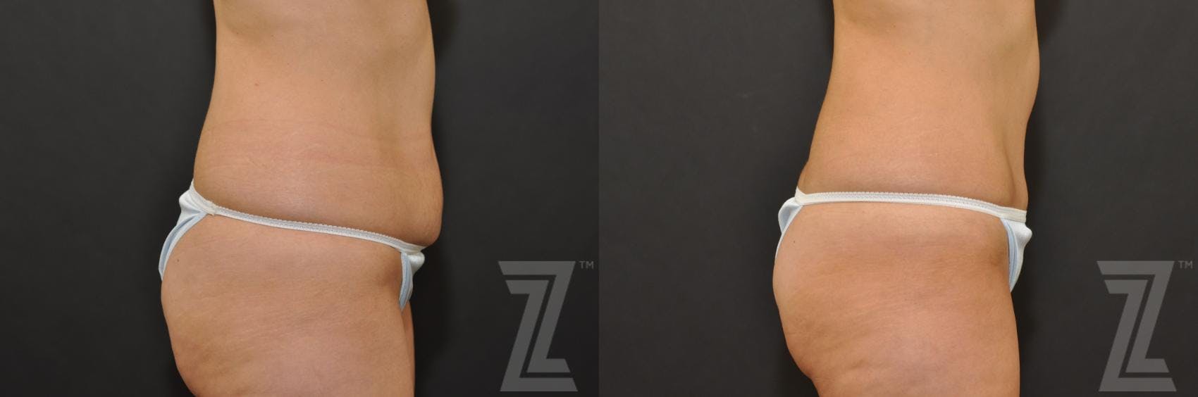 Tummy Tuck Before & After Gallery - Patient 132886896 - Image 4
