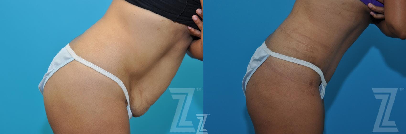 Tummy Tuck Before & After Gallery - Patient 132886898 - Image 5