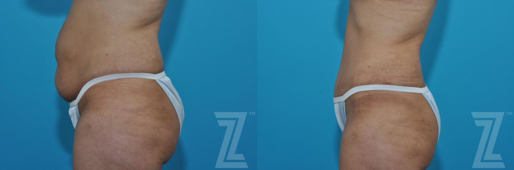 Tummy Tuck Before & After Gallery - Patient 132886901 - Image 2