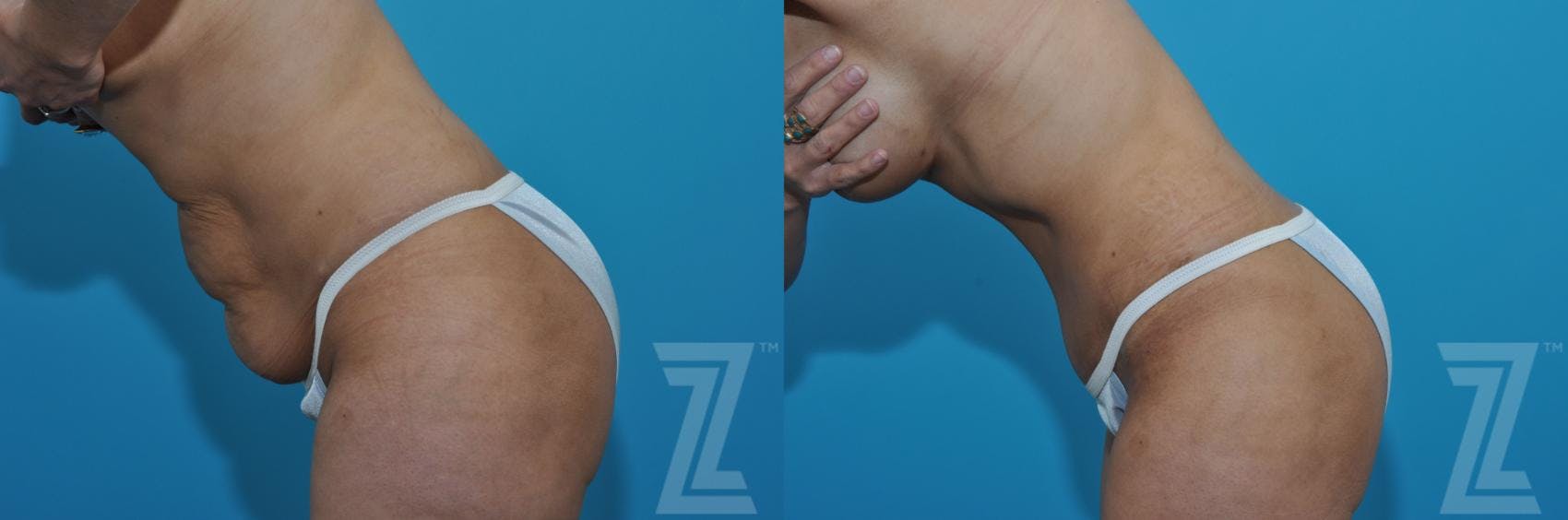 Tummy Tuck Before & After Gallery - Patient 132886901 - Image 3
