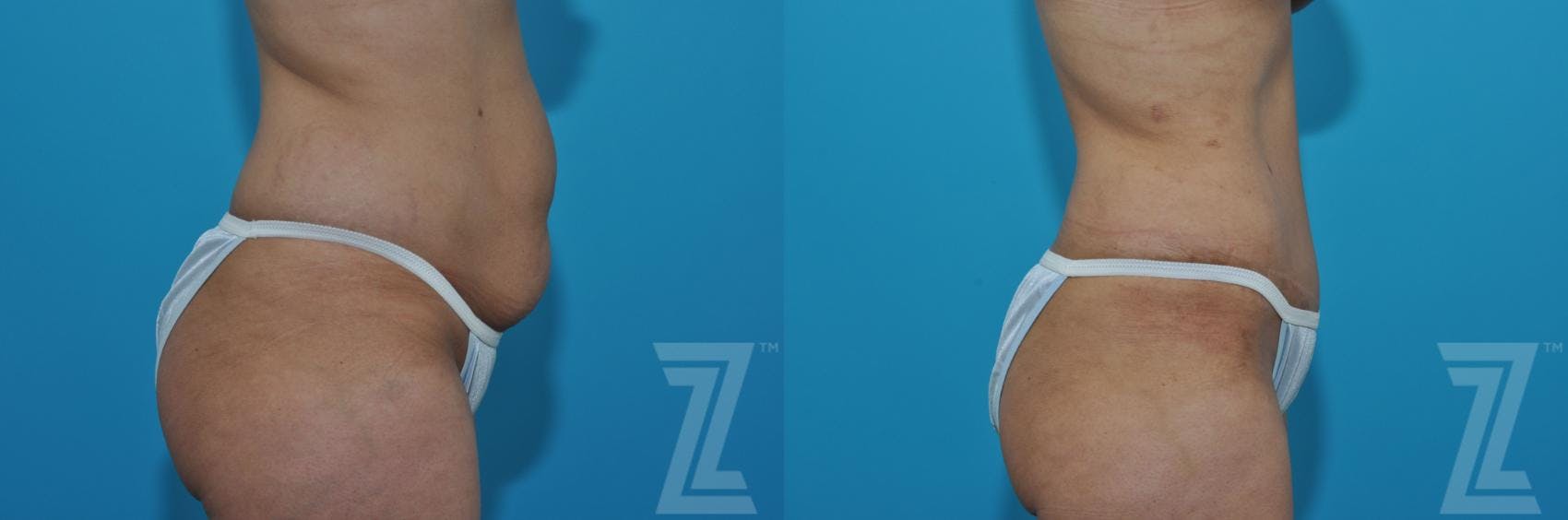 Tummy Tuck Before & After Gallery - Patient 132886901 - Image 4