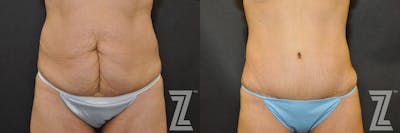 Austin Tummy Tuck Before & After Gallery - Patient 132886902 - Image 1 - The Piazza Center