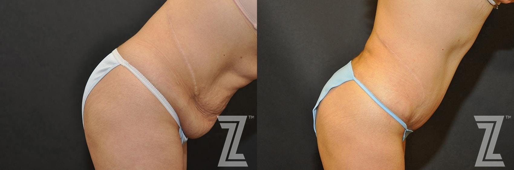 Tummy Tuck Before & After Gallery - Patient 132886902 - Image 6