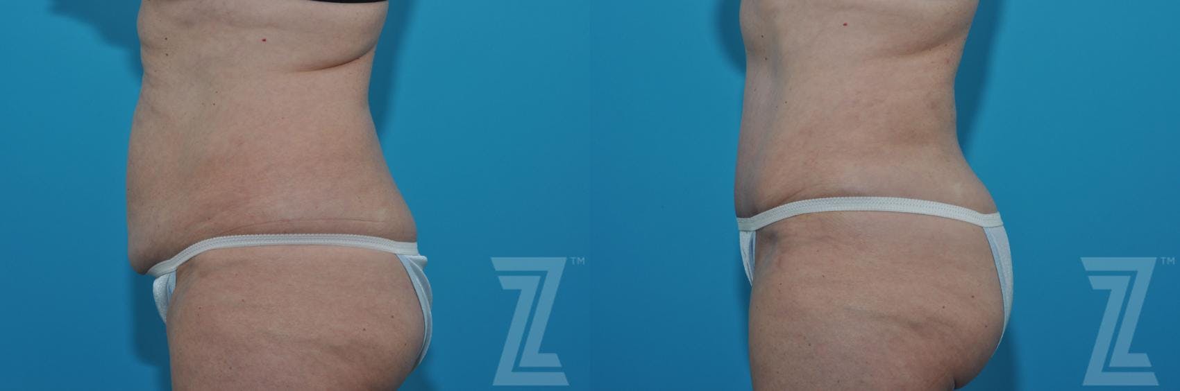 Tummy Tuck Before & After Gallery - Patient 132886903 - Image 2