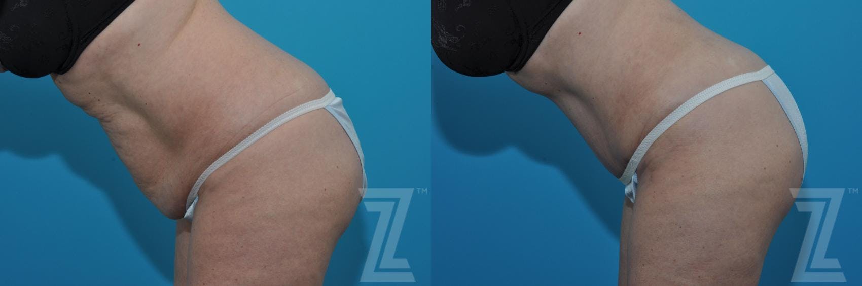 Tummy Tuck Before & After Gallery - Patient 132886903 - Image 3