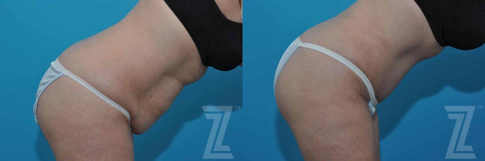 Tummy Tuck Before & After Gallery - Patient 132886903 - Image 5