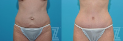Tummy Tuck Before & After Gallery - Patient 132886905 - Image 1