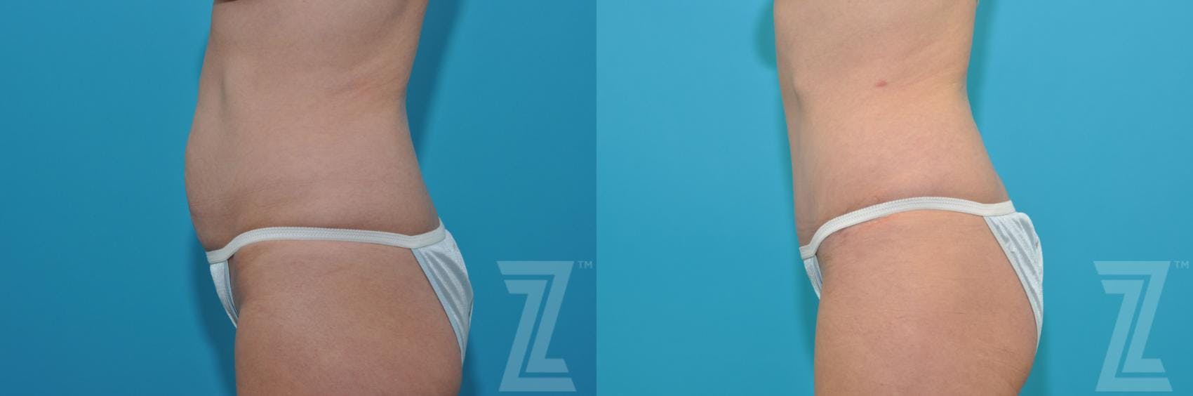 Tummy Tuck Before & After Gallery - Patient 132886905 - Image 2