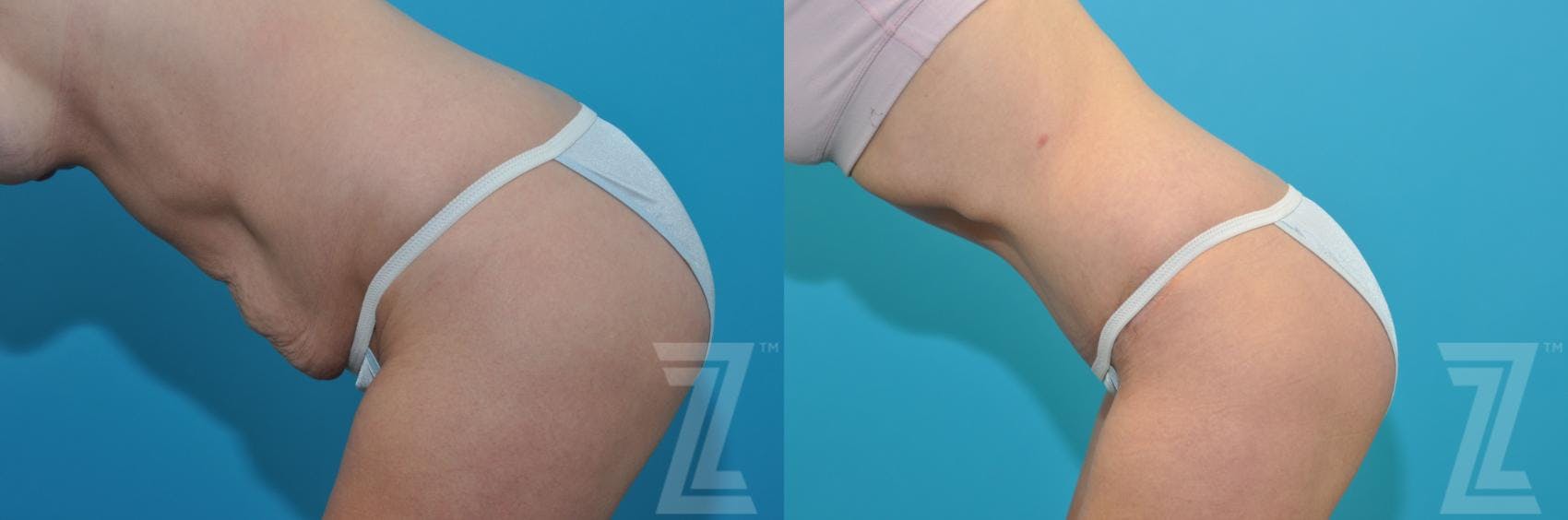 Tummy Tuck Before & After Gallery - Patient 132886905 - Image 3