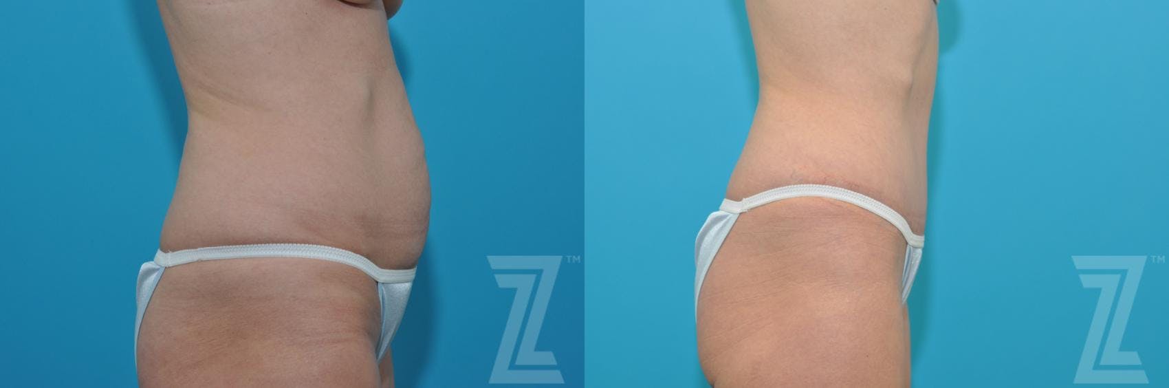 Tummy Tuck Before & After Gallery - Patient 132886905 - Image 4