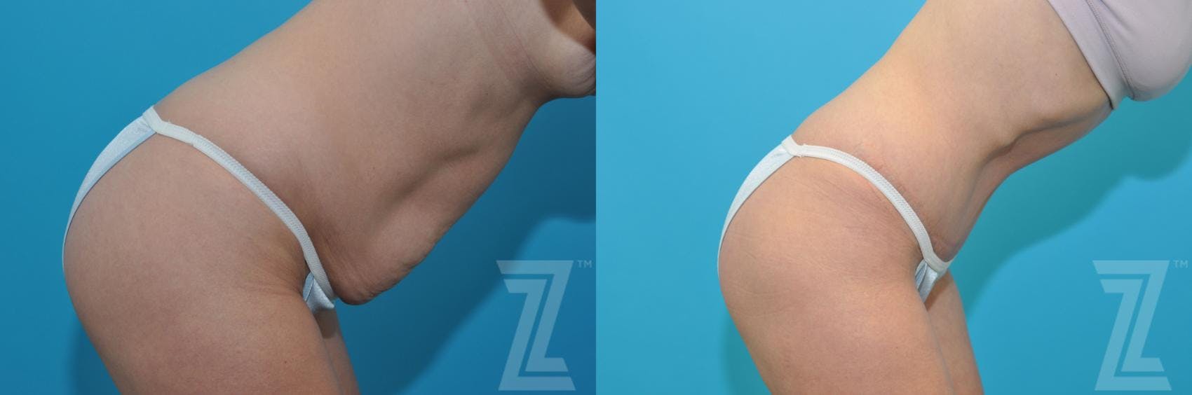 Tummy Tuck Before & After Gallery - Patient 132886905 - Image 5