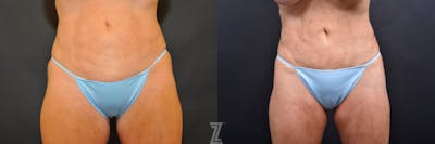 Austin Skin Pinch Before & After Gallery - Patient 132886906 - Image 1 - The Piazza Center