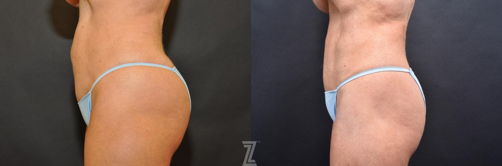 Skin Pinch Before & After Gallery - Patient 132886906 - Image 2